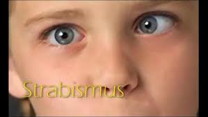 strabismus
